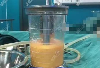 红河360度水动力吸脂费用多少钱？