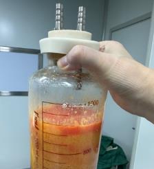 红河水动力吸脂手术要做多久？